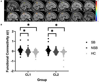 Increased Amygdala-Paracentral Lobule/Precuneus Functional Connectivity Associated With Patients With Mood Disorder and Suicidal Behavior